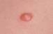 Pubic Area Removal Ingrown Hair