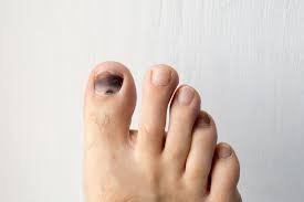 Berdasarkan butiran yang anda berikan 'onycholysis'. Waspadai Perubahan Warna Kuku Kaki Tandakan Ada Penyakit Halaman All Kompas Com