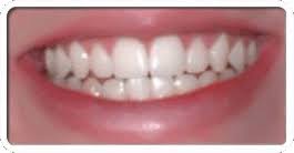 Dental bonding is one of the ways to treat the space between teeth problems. Teeth Gap Bands Close Gapped Teeth