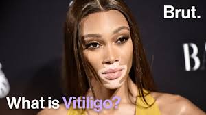 Image result for robert zaruba vitiligo