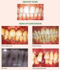 An inconsistent or poor oral care routine can lead to plaque buildup on the teeth. Gum Disease Symptoms Bleeding Gums Gum Abcesses Persistent Bad Breath National Dental Centre Singapore