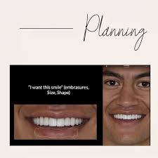Sometimes teeth wear down so slowly over so many years that it's hard to  visualise just how much tooth can be lost. This case is part of a  rehabilitation and begins with