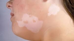 vitiligo ala hastaligi nedir nedenleri belirtileri ve tedavisi