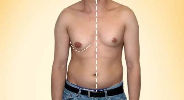 Gynecomastia Surgery Dubai | Male Breast Reduction | Dr Anshu