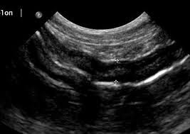 Intestinal tumors can be benign or malignant, though adenocarcinomas are malignant. Ultrasonography Of The Gastrointestinal Tract Ileum Cecum Colon Today S Veterinary Practice