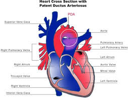 Pda meaning, definition, what is pda: Patent Ductus Arteriosus Pathophysiology Wikidoc