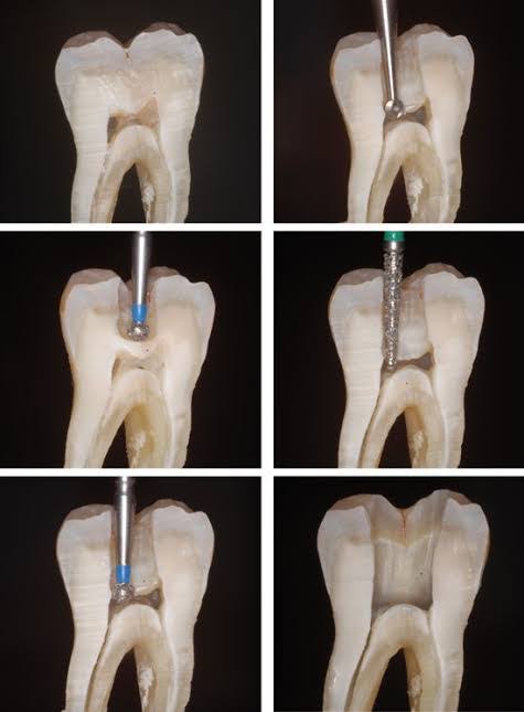 root canal treatment product image