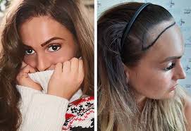 ‫زراعة الشعر في تركيا للنساء بمركز اليت هير | أكبر مستشفى لزراعة الشعر فى تركيا‬‎