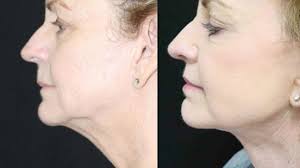 Do cardio every alternate day (do strength training on the other days) for at least 45 minutes. Double Chin Surgery What To Expect Cost Recovery More