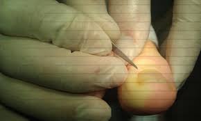 Image result for Akutní zánět nehtového lůžka