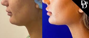 Since aging is a continual process, we recommend periodic treatments to maintain your results. Morpheus8 Skin Tightening Tampa Wrinkle Reduction St Petersburg Fl