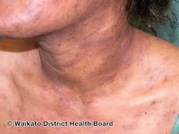 Image result for skin rash acute hiv infection