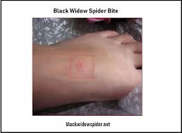 The venom from a black widow spider is poisonous. Black Widow Bite Symptoms Picture Latrodectus Bite Treatment