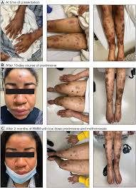 Image result for erythema nodosum
