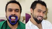 Full Mouth Rehabilitation with Dental Implants