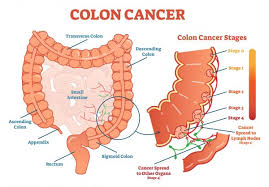 You find it hard to concentrate. 9 Signs That May Indicate Colon Cancer Does Your Belly Feel Bloated All The Time