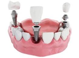 https://alphadentalcenter.com/services/dental-implant/
