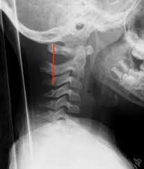 Here's what to expect with this painless procedure and why your dentist may recommend it. C Spine X Ray Interpretation Don T Forget The Bubbles