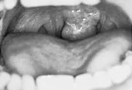 Image result for Uvulitis