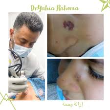 2 ما تفسير حلم الفراولة الحمراء للمتزوجة أما إذا رأت الفتاة العزباء في منامها ثمار الفراولة فهذا يشير إلى تركها حبيبها وأنها سوف تنساه. Elite Clinic Ø¥ÙŠÙ„ÙŠØª ÙƒÙ„ÙŠÙ†Ùƒ ÙˆØ­Ù…Ø© Ø§Ù„ÙØ±Ø§ÙˆÙ„Ø© Strawberry Nevus ÙˆØ­Ù…Ø© Ø¯Ù…ÙˆÙŠØ© Ø³Ù…ÙŠØª Ø¨Ù€ ÙˆØ­Ù…Ø© Ø§Ù„ÙØ±Ø§ÙˆÙ„Ø© Ù„ÙƒÙˆÙ†Ù‡Ø§ Ø­Ù…Ø±Ø§Ø¡ Ø¨Ù„ÙˆÙ† Ø§Ù„ÙØ±Ø§ÙˆÙ„Ø© ÙˆÙ‡ÙŠ Ø¹Ø¨Ø§Ø±Ø© Ø¹Ù† ØªØ¬Ù…Ø¹ Ø£ÙˆØ¹ÙŠØ© Ø¯Ù…ÙˆÙŠØ© Ø¯Ù‚ÙŠÙ‚Ø© Ø¹Ù„Ù‰ Ø³Ø·Ø­ Ø§Ù„Ø¬Ù„Ø¯ Ø£Ùˆ ØªØ­ØªÙ‡ Ù„Ø¯Ù‰