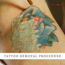 At genesis' tattoo removal in colorado springs, all of our laser technicians have advanced training and many years of laser experience. Ink Doubt Laser Tattoo Removal Inkdoubt Twitter
