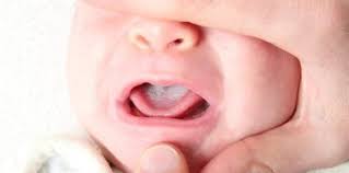 After cleaning the tongue, move your finger around the baby's mouth and gently massage the teeth and gums as well as the sides of the cheeks. Newborn Thrush Vs Milk Tongue Here How To Tell The Difference