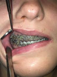 Surgery is usually done under general anesthesia. Jaw Surgery Faq Kimbermoose