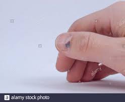 subunguales hamatom stockfotos und bilder kaufen alamy