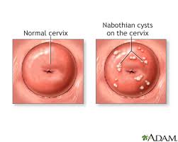 Nabothian Cyst Information Mount Sinai New York