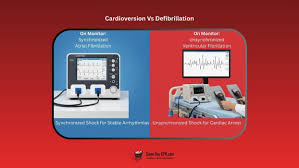 Image result for Synchronized Cardioversion