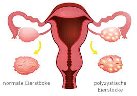 Because pcos is a syndrome, however, the presence of polycystic ovaries alone is insufficient for diagnosis. Polyzystisches Ovarsyndrom Pco Syndrom Ladr Wir Leben Labor