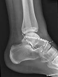 Image result for Calcaneus Compression Fracture