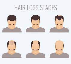 Common causes of hair loss How Much Hair Loss Is Normal A Guide For Young Gents The Bald Gent