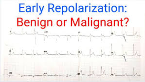 Image result for Early Repolarization