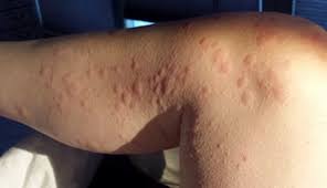 Leg rash information including symptoms, diagnosis, treatment, causes, videos, forums, and local community support. Chronic Hives Teaches Lessons About Life And Health