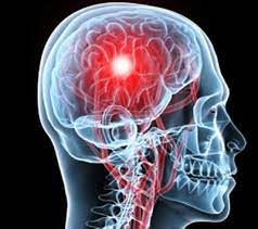 Scientific center of neurology, moscow. Trombosis Causas Sintomas Y Tratamiento De La Trombosis Pagina 3 De 5 Guia Medica Familiar