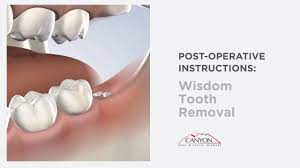 Post Operative Instructions Wisdom Teeth Removal At Canyon Oral Facial Surgery Dental Implant Experts