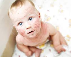 Image result for dermatitis contacta children