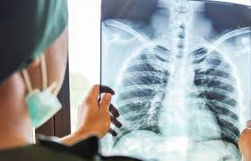 Various investigations are underway to reduce this disease. Early Screening For Lung Cancer Benefits Risks Of Ldct Scans