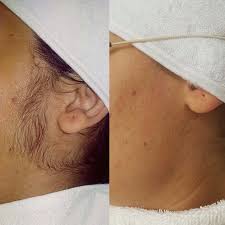 This means it may take multiple sessions to eliminate. Queens Laser Hair Removal In Birmingham Read 1 Review