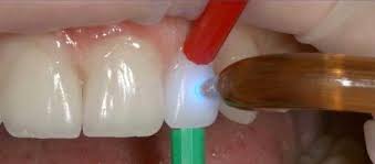 Place each veneer until all ten have been seated. Dvds David Hornbrook Dds
