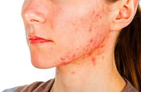 Biasanya, rasa sakit disertai gejala asam lambung naik dan perut kembung. Ini 4 Penyebab Jerawat Di Dagu Wajib Dielakkan Untuk Kulit Licin