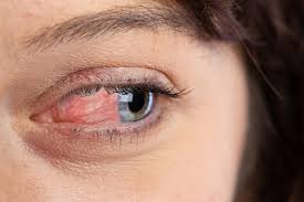 Image result for Conjunctivitis