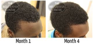 We do not recommend combing while your hair is dry. Do Your Hair Loss Treatments Work On Black Men