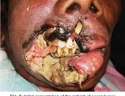 Myiasis is the parasitic infestation of the body of a live animal by fly larvae (maggots) which grow inside the host while feeding on its tissue. Oral Myiasis A Pauper S Affection Case Reports And A Review Of 62 Cases Semantic Scholar