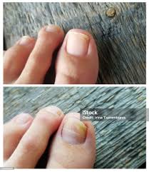 Image result for Onycholysis feet