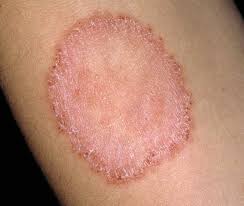 Cover all surfaces of both hands with the sanitizer. Ringworm Signs Symptoms And Complications