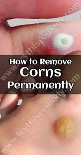 How To Remove Corns Permanently Corn Removal Get Rid Of Corns Toe Corn Removal