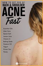Home Remedies For Back Acne Causes Treatment And Prevention Tips Shoulder Acne Skin Care Remedies Back Acne Treatment