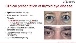 Image result for Proptosis